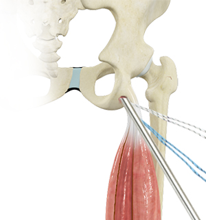 Endoscopic Proximal Hamstring Repair