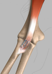distal biceps tendonitis