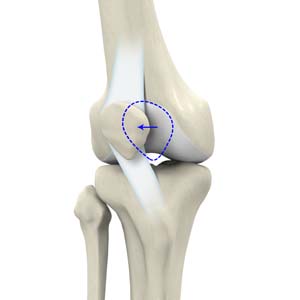 knee surgery for dislocated kneecap
